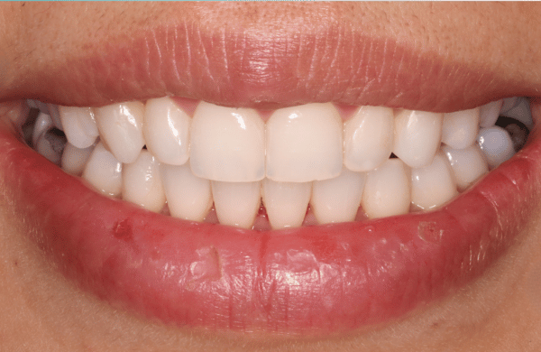 After - brecknockdental