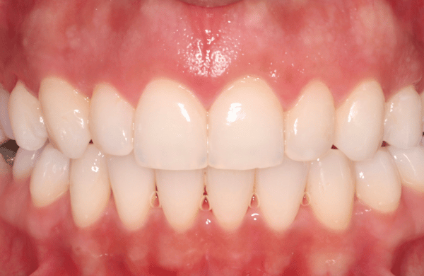 After - brecknockdental