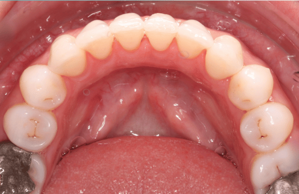 After - brecknockdental